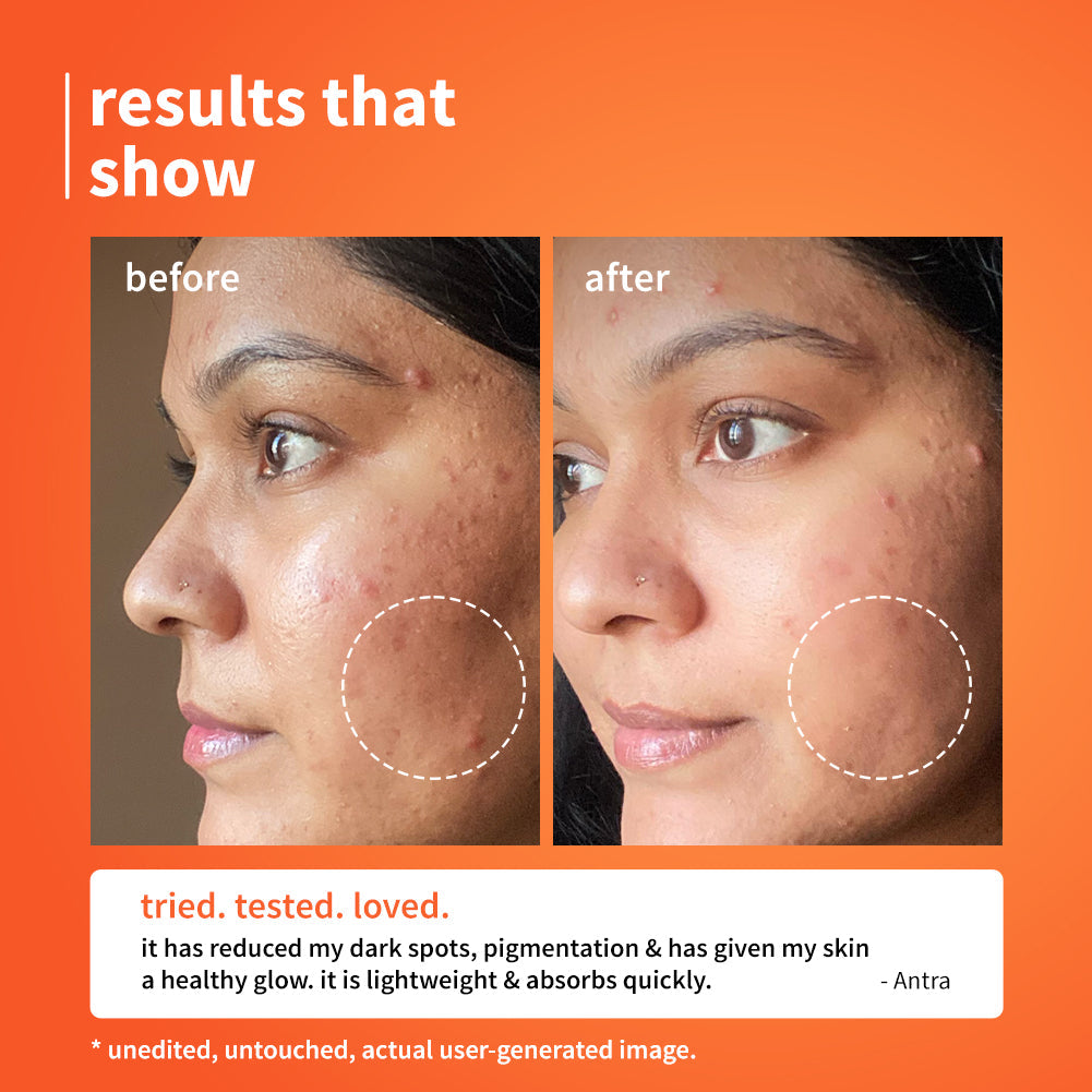 Plum 10% Vitamin C Barrier Boosting + Glow Serum with Calendula | Boosts Glow From 1st Use | Fades Dark Spots In 14 Days | Dermat-Tested, 30ml