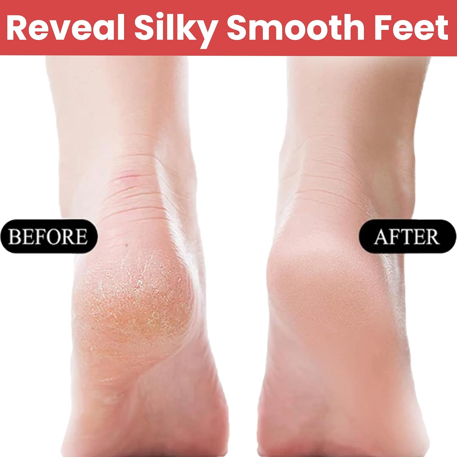 Before and after results of callus removal