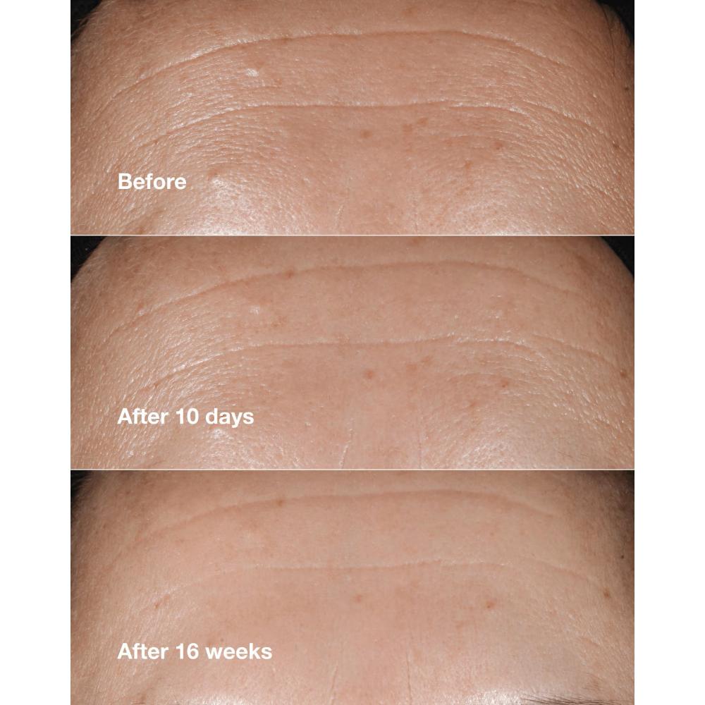 Clinique Smart Clinical Repair Wrinkle Correcting Serum With Retinoid, 50ml